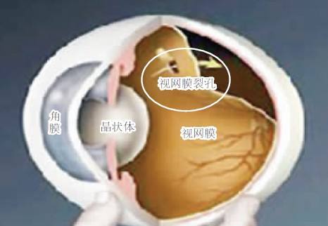视网膜脱落1.jpg