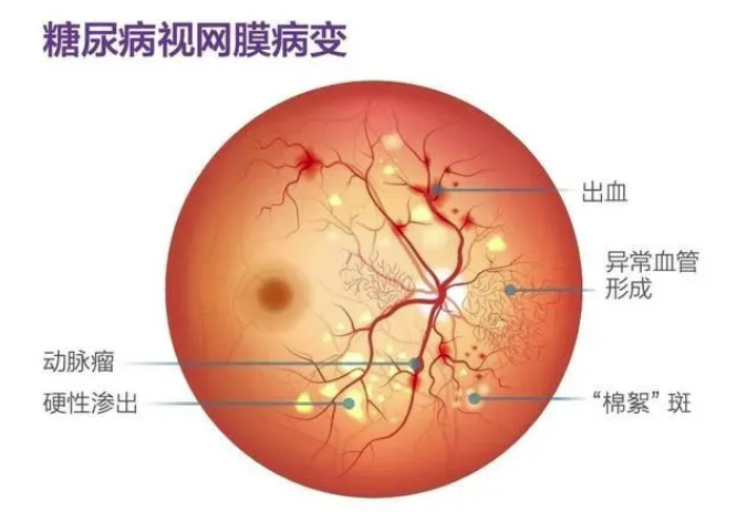 越甜越爱,越爱越痛,这个糖尿病并发症不容小觑!(图1) 越甜越爱,越爱越痛,这个糖尿病并发症不容小觑!(图1)