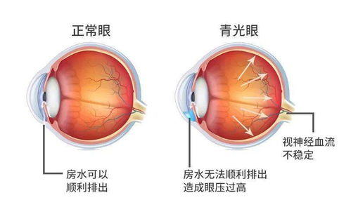 医生说眼病丨青光眼就是眼压高？(图1)