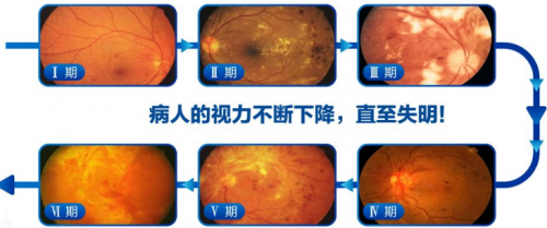 兰州爱尔陈雪艺院长：“糖网”是个什么网？早期难发现晚期可致盲(图1)