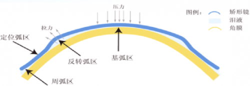 兰州爱尔眼科医院范真院长科普：带您详细了解角膜塑形镜，让孩子在睡梦中摘掉眼镜(图3)