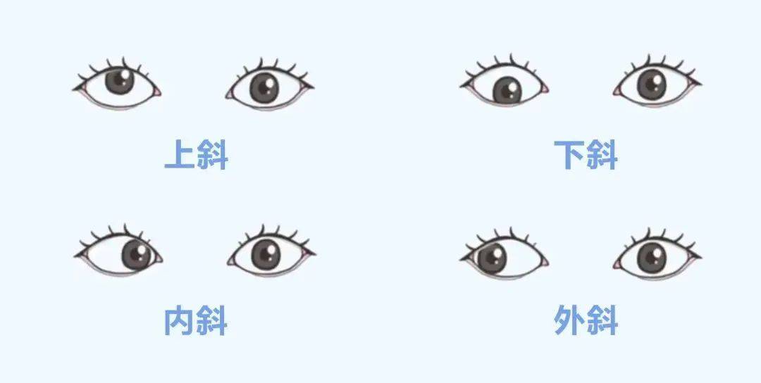 兰州爱尔眼科范真院长：孩子斜视只影响美观？远远不止！(图3)