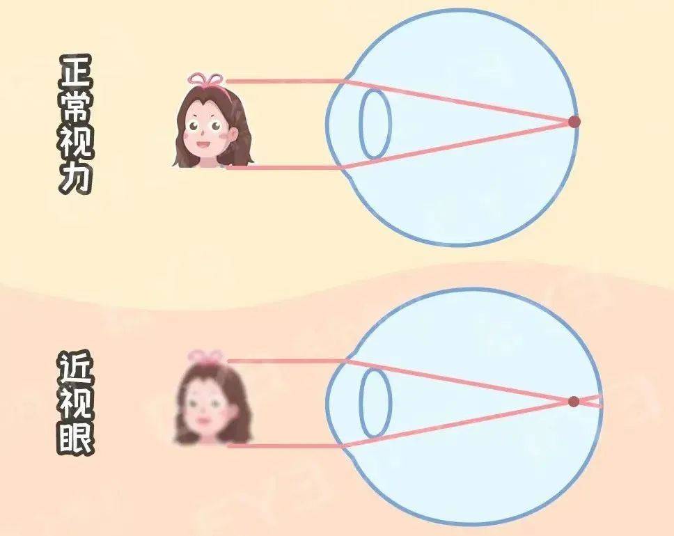 兰州爱尔眼科医院：近视手术后视力达到多少，手术才算成功(图3)