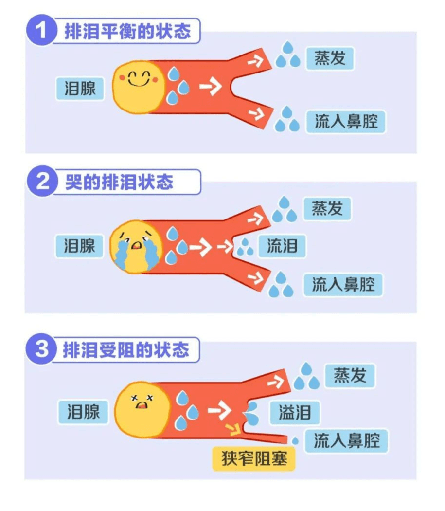 兰州爱尔眼科医院丨泪道阻塞有什么危害，怎么治疗？(图2)