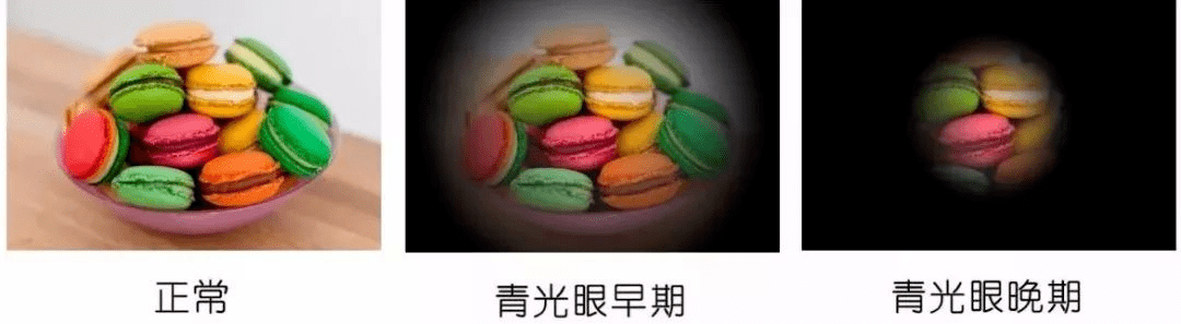 兰州爱尔眼科医院丨青光眼是导致失明的三大致盲眼病之一，早期有何症状(图2)