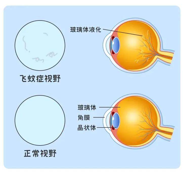 兰州爱尔眼科陈雪艺院长：眼前总有“蚊子”飞，能做近视手术吗？ (图1)